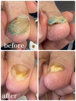爪屋/変形し、厚くなってしまった爪