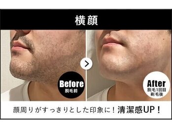 RBL ゆめタウン三豊店/メンズ脱毛/ヒゲ脱毛1回目剃毛後