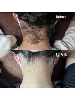 ネオオアシス トウキョウ(ネオOASIS TOKYO)/【W脱毛】夏に向けて脱毛