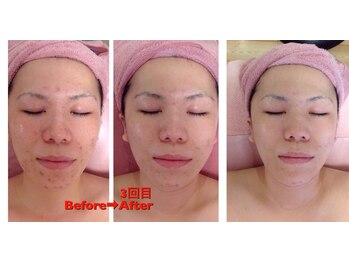 エステティックサロン ココチ(Cocochi)/ガンコな肌荒れも◎