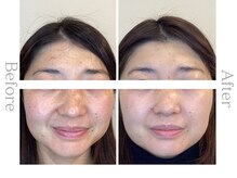 ブルースター/極潤リフトマスク