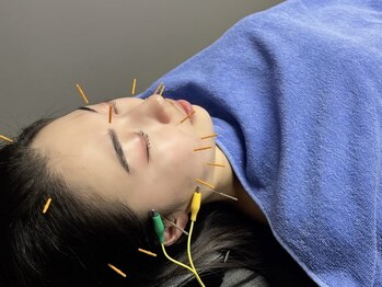 ウィズ鍼灸整骨院 十三院(with.鍼灸整骨院)の写真/お顔の悩みは美容鍼で解決☆リフトアップ/むくみ解消の徹底改善☆お肌のハリツヤ・肌弾力UPにも♪