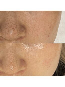 ユキエル(yukielle)/ビフォーアフター