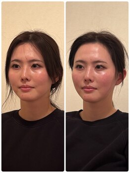 あかり鍼灸 接骨院プラス 南草津院(あかり鍼灸 接骨院PLUS)の写真/『最近お肌のハリが気になり始めた方必見』熟練の鍼灸師による本格美容鍼で、横顔まで美しいツヤ肌へ♪