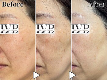ラヴレボーテ(La Vraie Beaute)/50代・シミ しわ・改善期間9ヶ月