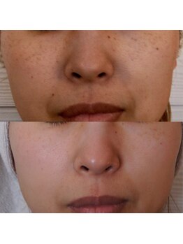 トラット エステアンドアイズ(tratto)/30代　お客様症例写真