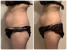 オンディーヌ ハナレ 名古屋店(HANARE)/オーダーメイド痩身１回で！