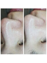 ミミーモリオカ(MiMiy MORIOKA)/ハーブピーリング＋毛穴洗浄