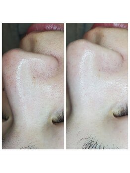 ミミーモリオカ(MiMiy MORIOKA)/ハーブピーリング＋毛穴洗浄