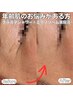 【夏限定☆】35歳からの透明肌×ハリ感UPプラズマエクソソーム導入 4500円