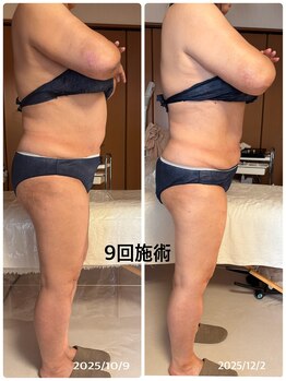 ジフィー(Gify)/筋膜リリースカッターBody