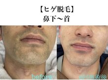 private salon Ark【アーク】大河原 光脱毛/フェイシャル/リンパマッサージ/ネイルの雰囲気(メンズのご来店も多数!ヒゲ脱毛が大人気です)