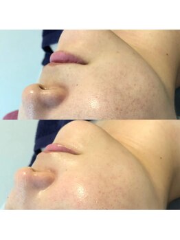 アイラッシュ ラピス(Lapis)/REVI陶肌トリートメント