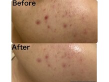 マスカレード(Masquerade)/【クリスティーナ症例写真】