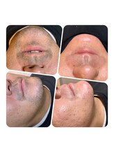 トゥルーカインド(true kind)/ヒゲダブル脱毛(WAX+光)