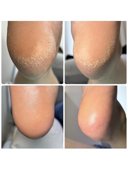 巻き爪補正店 柏店/かかとの角質ケア ¥5500