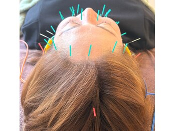 アプレシエ(Apprecier)/リフトアップ/小顔/左右差など