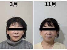 ミヤビ(miyabi)/小顔矯正