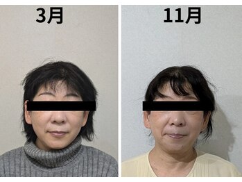 ミヤビ(miyabi)/小顔矯正