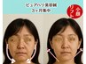 【1月限定/那覇久米】深層から引き上げる小顔リフトアップ美容鍼¥5,980