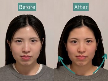 カンワ美容鍼灸院(KANWA美容鍼灸院)/20代女性たるみ、食いしばり