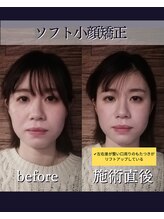 ヘッドラボ(Headlabo★3103)/ソフト小顔矯正