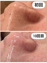 ミリ(MiLi)/毛穴エクストラクション