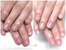 インブロッサム(imblossom)/深爪矯正/自爪育成