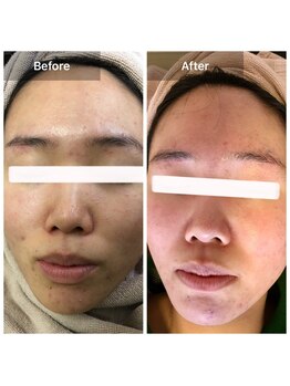 モカ 天王寺店(MOKA)/剥離5回　顎ニキビ　毛穴剥離