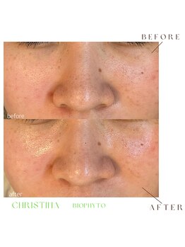 シェア(share.)/剥離なしハーブピーリング