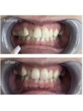 エクシアホワイトニング 津駅前店/お客様ビフォーアフター