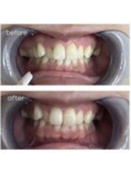 エクシアホワイトニング 津駅前店/お客様ビフォーアフター