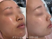 カレンジェビューティー(CarengeBeauty)/ダクトピール＋LED1回