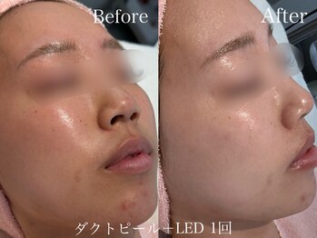 カレンジェビューティー(CarengeBeauty)/ダクトピール+LED1回
