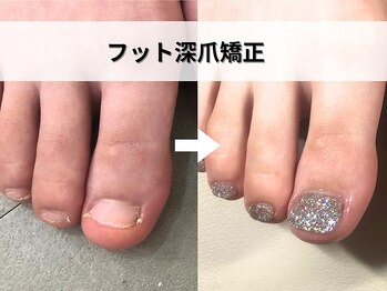ブルームーンネイルズ(BLOOMOON.nails)/フット深爪矯正