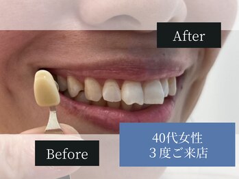 ホワイトニングカフェ 姫路駅前店(WhiteningCafe)/ホワイトニング3度ご来店