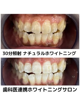 プラチナムビューティ 四条烏丸店(PLATINUM Beauty)/ホワイトニング！Before./After!