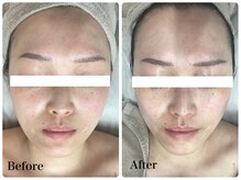 ルピア(L'pur)/小顔