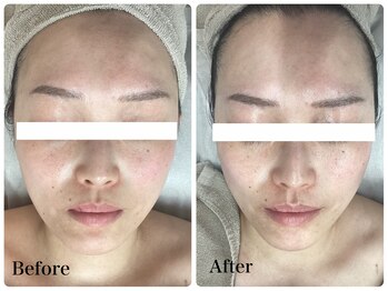 ルピア(L'pur)/小顔