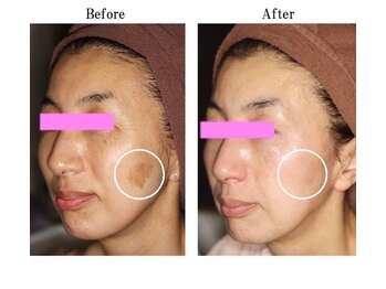 ヴィーナスハート/☆お肌改善フェイシャル☆