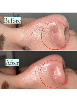 キレミラ 麻布十番店/毛穴洗浄before/after【1回】