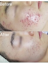 ロイヤル(ROYAL)/男性にも◎赤み/ニキビ改善！