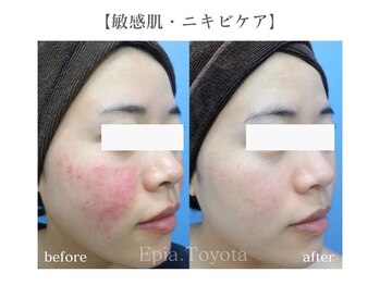 エピア 豊田店(Epia)/敏感肌の方も安心のニキビケア