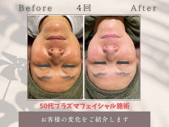 トータルビューティー雅/プラズマフェイシャルの凄さ見て