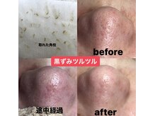 ビューティーネイル(Beauty Nail)/毛穴エクストラクション