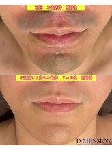 ディメンション 新宿(DiMENSION)/当店の髭脱毛は本当に早いです。