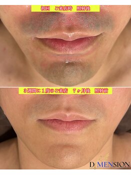 ディメンション 新宿(DiMENSION)/当店の髭脱毛は本当に早いです。