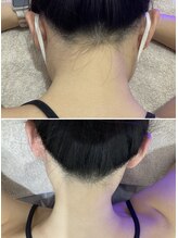 セラス(CERAS)/えりあし脱毛