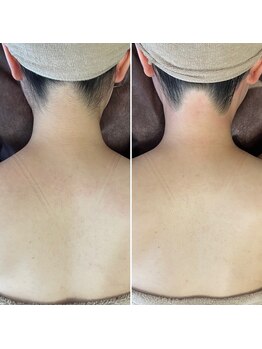 エピナ 秋田店(Epina)/うなじMIX脱毛+背中光脱毛★