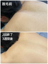 ワイズサロン(Y's salon)/男性の背中脱毛